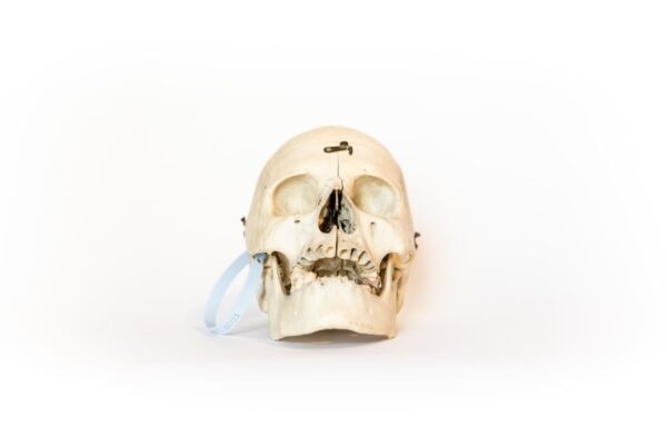 Medical Skull With Bruxism (0123)