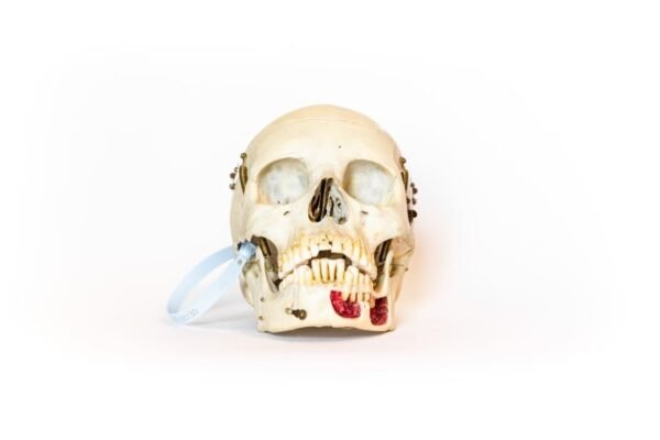 Medical Skull With Exposed Teeth Roots (0130)