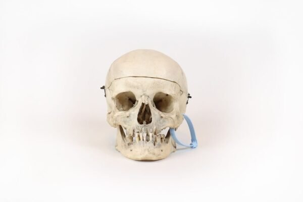 Medical Skull With Healed Trauma (0171)