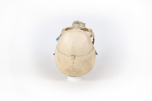 Medical Skull With Healed Trauma (0171) - Image 4