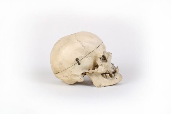 Medical Skull With Healed Trauma (0171) - Image 3