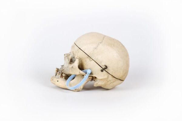 Medical Skull With Healed Trauma (0171) - Image 2