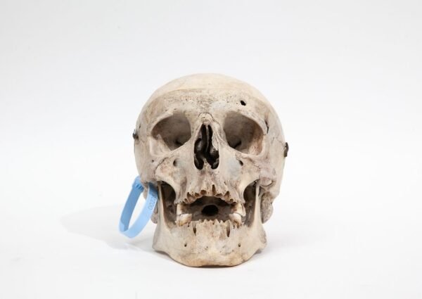 Trepanned Medical Skull (0228)
