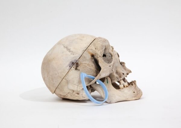 Trepanned Medical Skull (0228) - Image 3