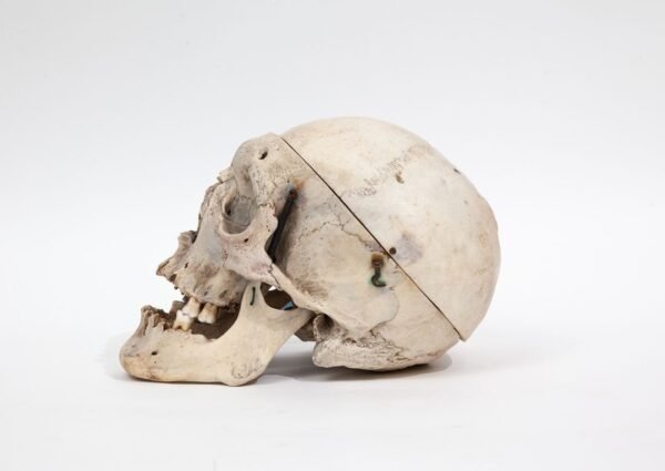 Trepanned Medical Skull (0228) - Image 2