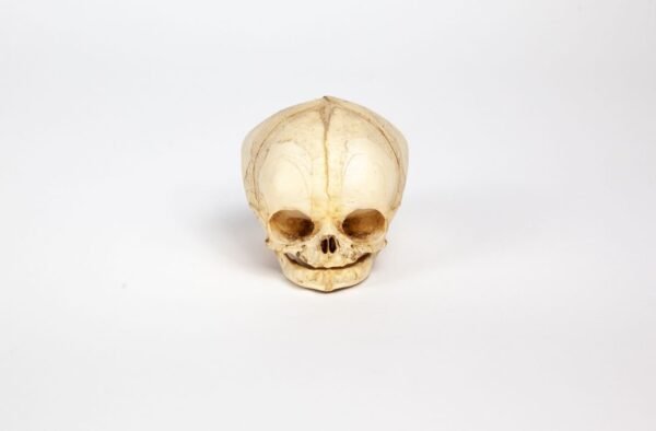 Fetal Skull