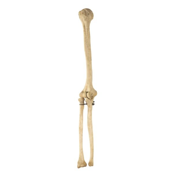 Radius, and Ulna

26137