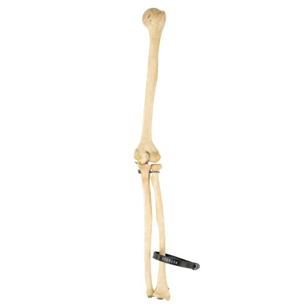 Radius, and Ulna

26124