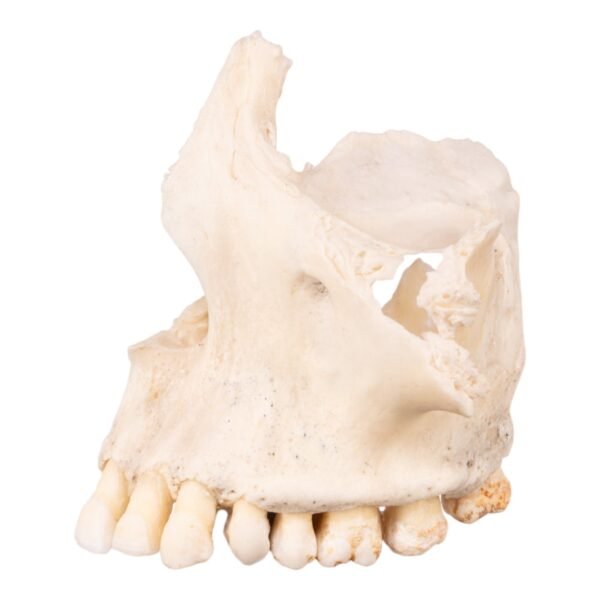 Half Maxilla