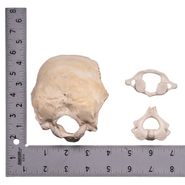 Occipital Bone, Axis, and Atlas
30227 - Image 3