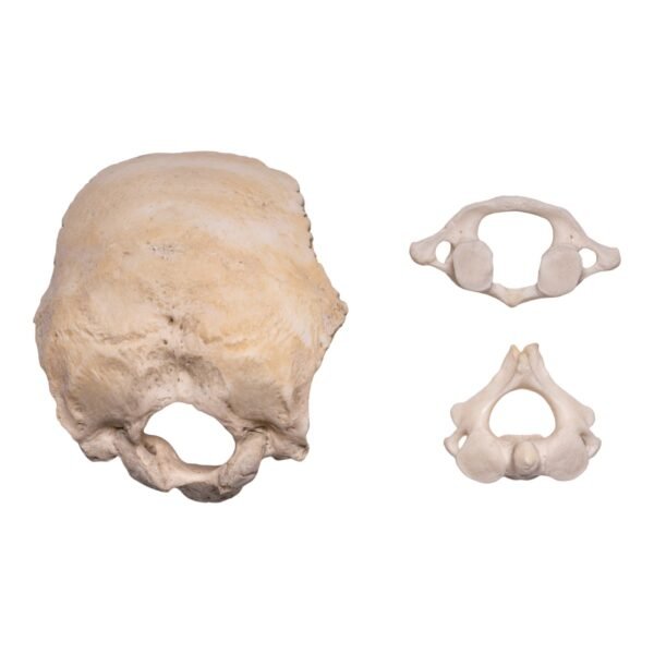 Occipital Bone, Axis, and Atlas
30227