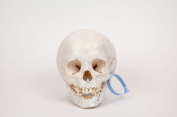 Pediatric Skull with Minor Hydrocephaly (0299)