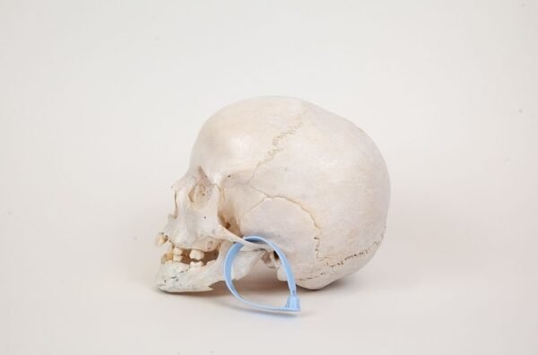 Pediatric Skull with Minor Hydrocephaly (0299) - Image 2