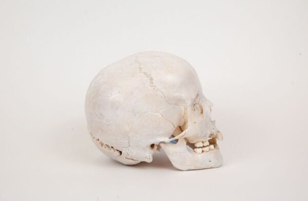 Pediatric Skull with Minor Hydrocephaly (0299) - Image 3