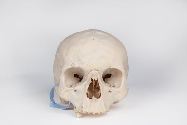 Uncut Medical Skull with Signs of Syphilis (0396) - Image 3