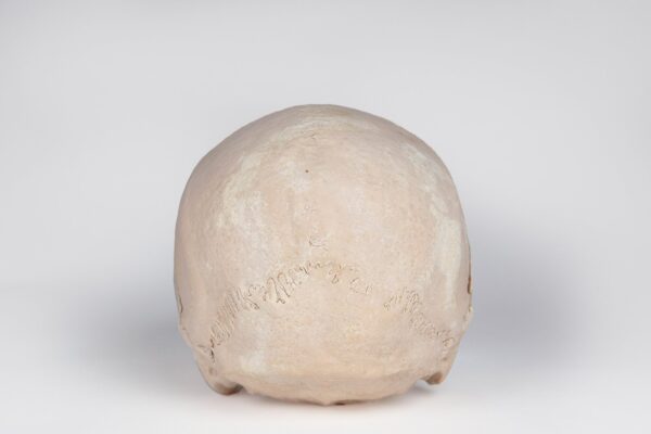 Uncut Medical Skull with Signs of Syphilis (0396) - Image 4
