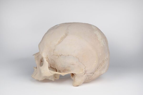 Uncut Medical Skull with Signs of Syphilis (0396)