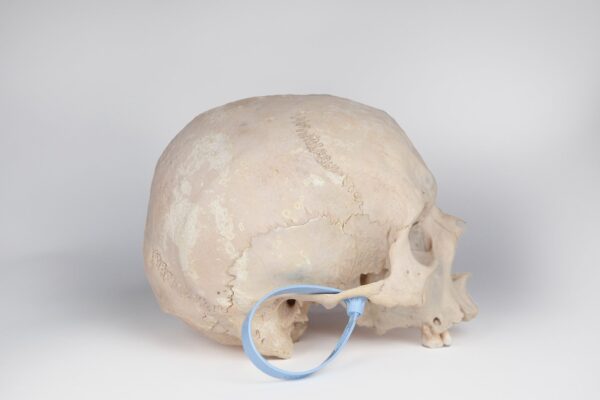 Uncut Medical Skull with Signs of Syphilis (0396) - Image 2